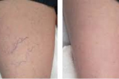 Excel-V_spider-veins