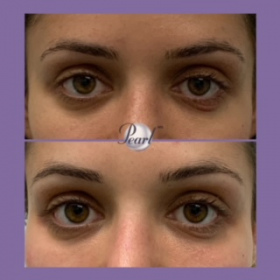 Tear-Trough_031721-1