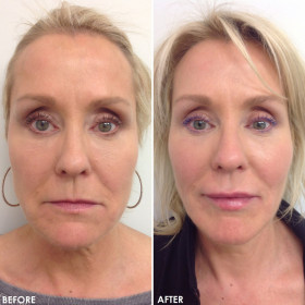 BA-Facial-Contouring-2