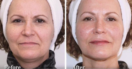 BA-Facial-Contouring-5