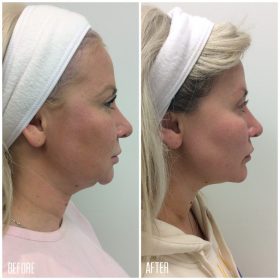 Facial-Contouring-1-1200x1200