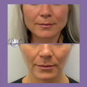 Jaw-Reduction_Botox_031721-1