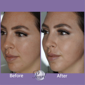 facial-contouring