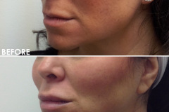 BA-Facial-Contouring-1