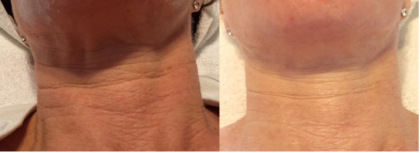 forma_neck