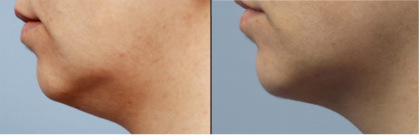 formaa_neck