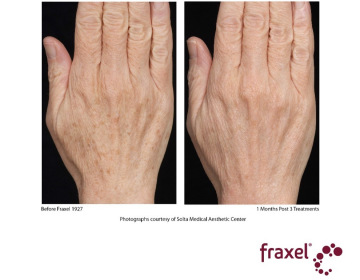 Fraxel_hands-2