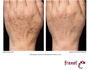 Fraxel_hands