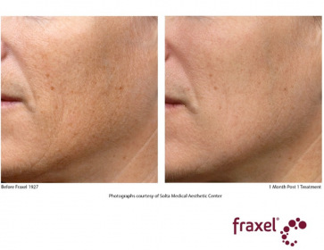 Fraxel_hyperpigmentation-2