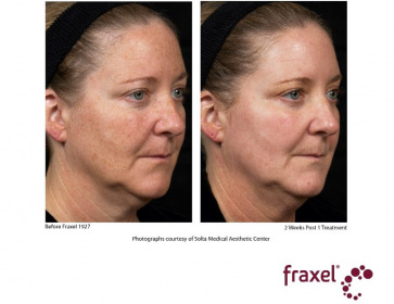 Fraxel_hyperpigmentation