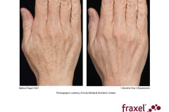 Fraxel_hands-2