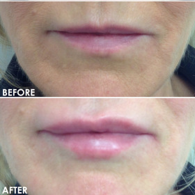 BA-Lips-1