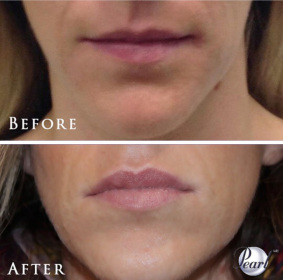 BA-Lips-10