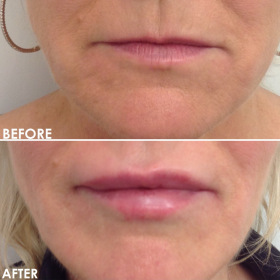 BA-Lips-2