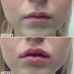 BA-Lips-3