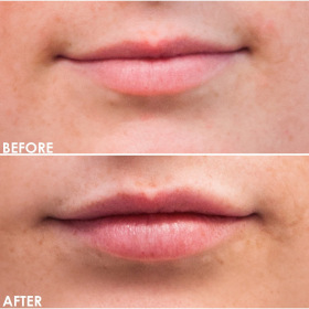 BA-Lips-5