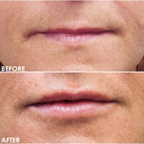 BA-Lips-6