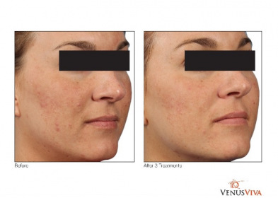 venus__hyperpigmentation