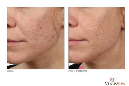 venus_acne-scars