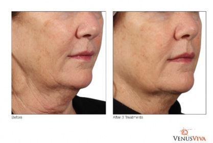 venus_under-chin