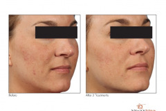 venus__hyperpigmentation