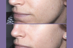 Pearl Laser Peel