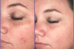 Gloss-peel-1200x1200