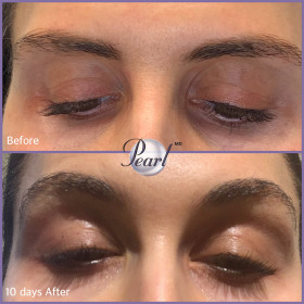 plasma-eye-lift