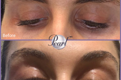 plasma-eye-lift