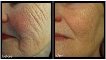 profound-before-after-1