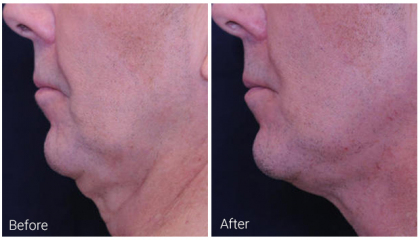 profound-before-after-2