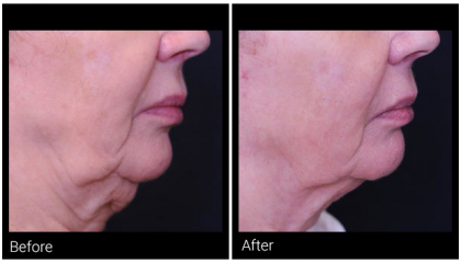 profound-before-after-3