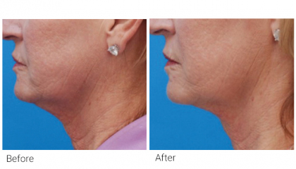 profound-before-after-4