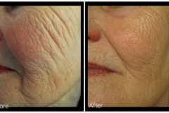 profound-before-after-1