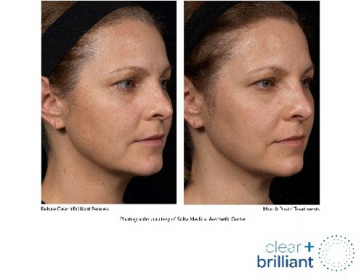 clear-and-blue_face-rightside