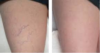 Excel-V_spider-veins