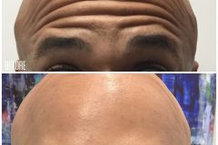 Wrinkle Correction (Botox, Dysport)