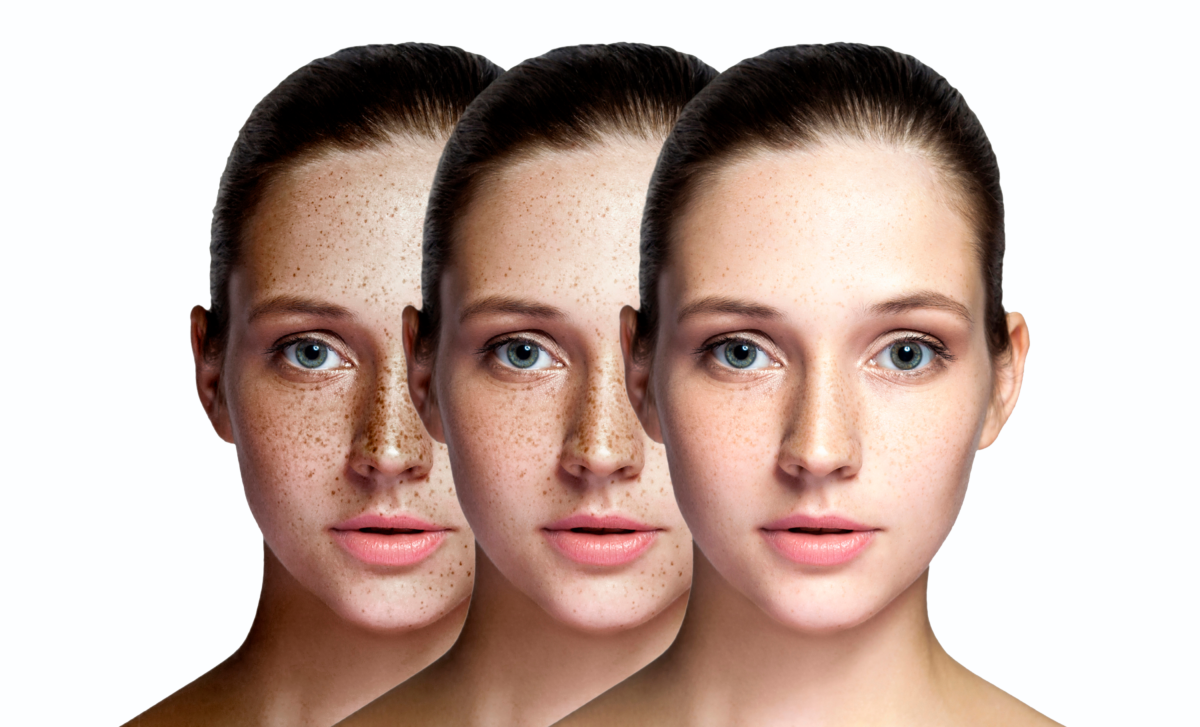 hyperpigmentation fraxel fade freckles 