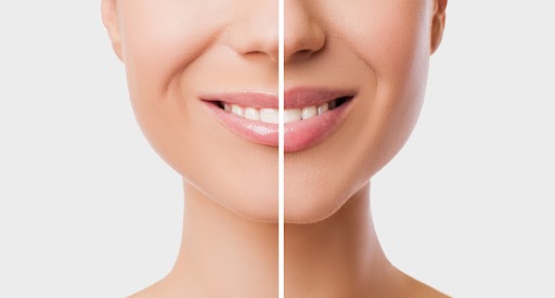 Lip Enhancement