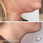 Belkyra double chin before and after result at PearlMD Toronto case 2