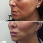 Facial contouring before and after result at PearlMD Toronto case 1