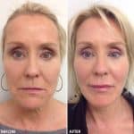 Facial contouring before and after result at PearlMD Toronto case 2