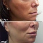 Facial contouring before and after result at PearlMD Toronto case 3