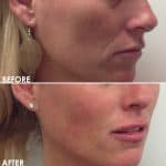 Facial contouring before and after result at PearlMD Toronto case 4