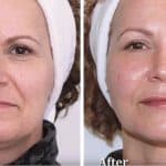 Facial contouring before and after result at PearlMD Toronto case 5