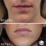 Lip enhancement before and after result at PearlMD Toronto case 10