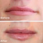 Lip enhancement before and after result at PearlMD Toronto case 11