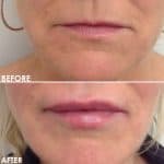Lip enhancement before and after result at PearlMD Toronto case 2