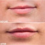 Lip enhancement before and after result at PearlMD Toronto case 5