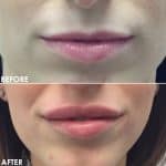 Lip enhancement before and after result at PearlMD Toronto case 9